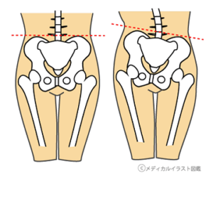 長崎市で唯一の 慢性腰痛 専門 カイロ整体レディキュア 女性専門 095 5 93 ブログ 18 09 01 土 知ってる 簡単に 骨盤矯正する方法 カテゴリー 股関節 腰痛 自分でできる改善法 知ってる 簡単に骨盤矯正する方法 腰痛を持っているあなた